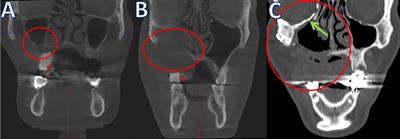 A New Strategy for Patient-Specific Implant-Borne Dental Rehabilitation in Patients With Extended Maxillary Defects